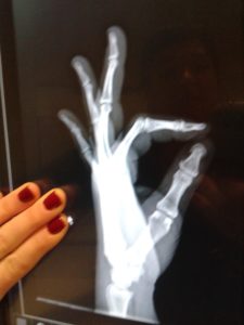 X-ray of hand making the "OKAY" symbol