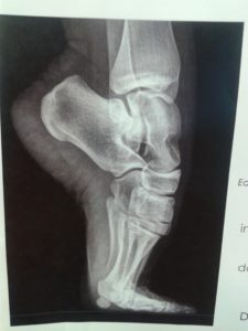 X-ray of foot on tip-toes