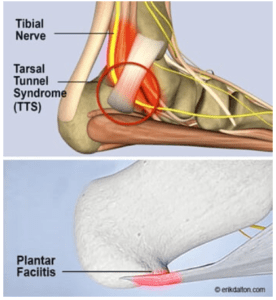 Plantar fasciitis